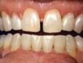 Veneers
