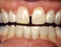 Veneers