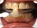 Teeth Whitening